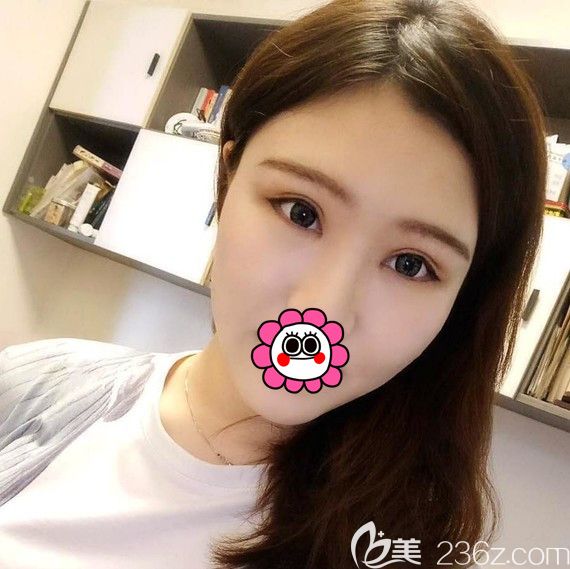 雙眼皮修復(fù)一個月<span style=