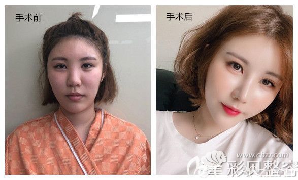 客戶做的是鼻部綜合手術(shù) 客戶做的是鼻部綜合手術(shù)