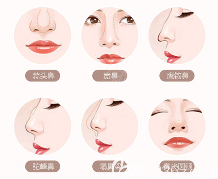 深圳<!--<i data=20240703-sp></i>-->醫(yī)院朱輝醫(yī)生隆鼻優(yōu)勢(shì) 深圳<!--<i data=20240703-sp></i>-->醫(yī)院朱輝醫(yī)生隆鼻優(yōu)勢(shì)