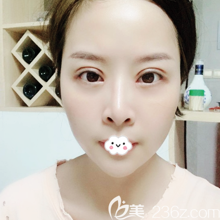 <!--<i data=20240703-sp></i>-->整形醫(yī)院脂肪填充案例20天效果圖