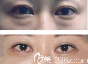 包頭葉子整形美容醫(yī)院眶隔釋放去眼袋效果