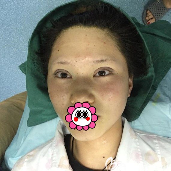 龔濤做完雙眼皮后的效果