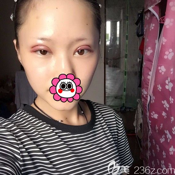 雙眼皮術(shù)后第二天進(jìn)入腫脹期