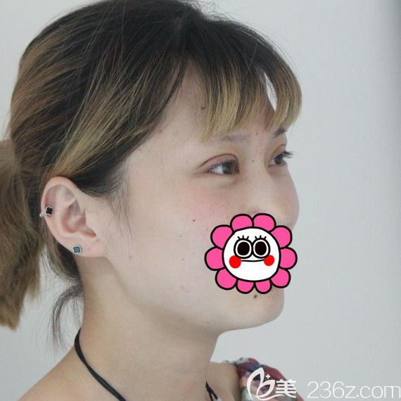 雙眼皮術(shù)后七天拆線