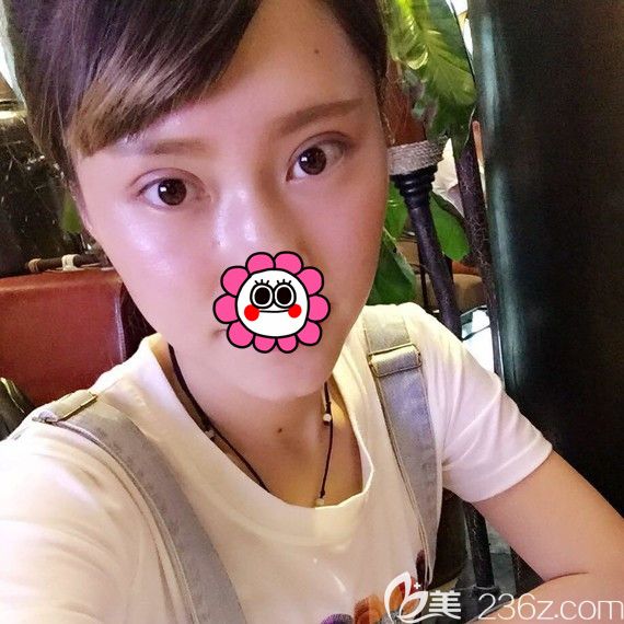 寧波雅韓雙眼皮恢復(fù)一個(gè)月效果