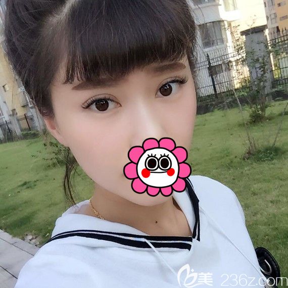 都說寧波雅韓龔濤做鼻子效果好，我覺著他給我做的雙眼皮效果也挺滿意的