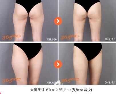 韓國365mc醫(yī)院吸脂瘦大腿真人前后對比照