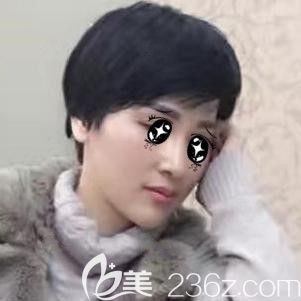 注射伊婉玻尿酸墊下巴術后25天下巴自然 注射伊婉玻尿酸墊下巴術后25天下巴自然