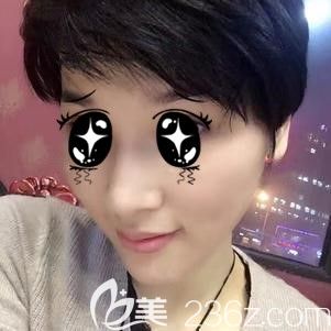 到太原時光做玻尿酸墊下巴術后45天恢復效果 到太原時光做玻尿酸墊下巴術后45天恢復效果