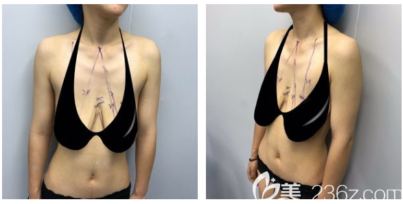 深圳南雅醫(yī)療美容整形門診部姚成紅術(shù)前照片1