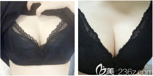 深圳南雅姚成紅醫(yī)生花苞精 雕提升手術(shù)真實(shí)三個(gè)月 深圳南雅姚成紅醫(yī)生花苞精 雕提升手術(shù)真實(shí)三個(gè)月