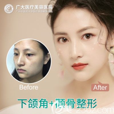 廣州廣大整形醫(yī)院柳超做的顴骨下頜角整形<span style=