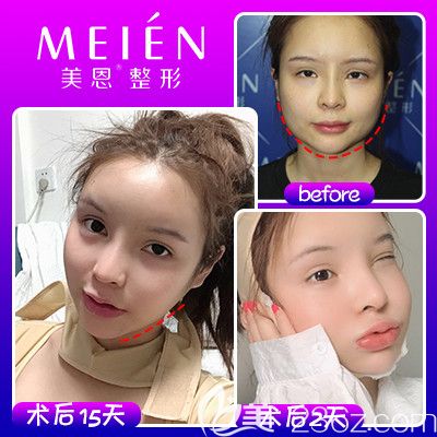 廣東廣州美恩徐威強(qiáng)做的下頜角改臉型<span style= 廣東廣州美恩徐威強(qiáng)長(zhǎng)曲線下頜角