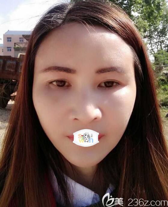 孝感面部年輕化哪家好？天妃脂肪豐面案例