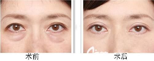 祛眼袋手術(shù)1-10天恢復(fù)效果圖 祛眼袋手術(shù)1-10天恢復(fù)效果圖