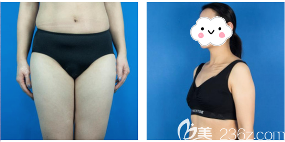 說說我面診深圳多家醫(yī)院后選擇深圳yestar藝星整形常德成做大腿吸脂的親身經(jīng)歷和感受 說說我面診深圳多家醫(yī)院后選擇深圳yestar藝星整形常德成做大腿吸脂的親身經(jīng)歷和感受