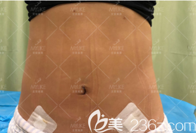 劉曉榮醫(yī)生給我做腰腹環(huán)吸當天手術(shù)即刻照