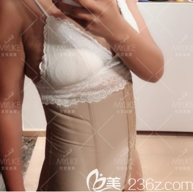 我在北京美萊做腰腹環(huán)吸第20天效果