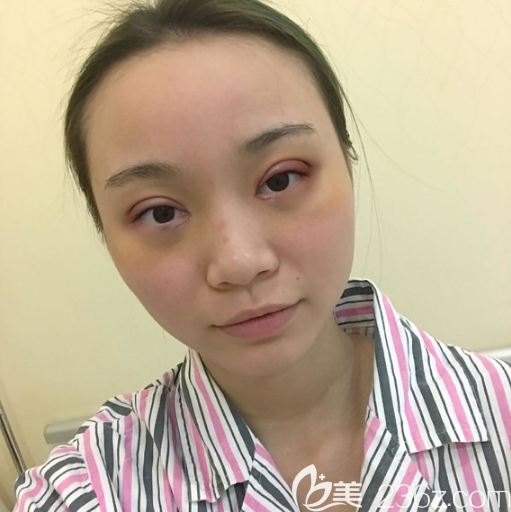 廣州余花醫(yī)生雙眼皮術(shù)后7天效果圖