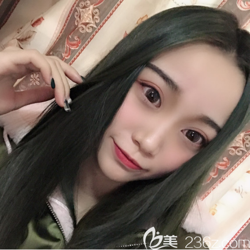 廣州愛來割雙眼皮哪個醫(yī)生好？余花全切雙眼皮案例恢復(fù)過程圖分享