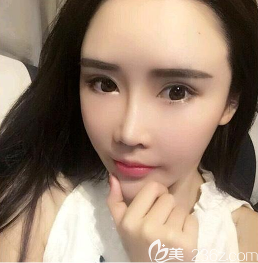 鼓氣勇氣找廣州愛來整形醫(yī)院余花醫(yī)生做了隆鼻和面部自體脂肪填充