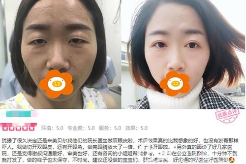 福州美貝爾趙棟材醫(yī)生切開雙眼皮+開眼角前后對比圖