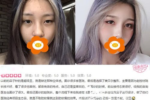 福州美貝爾趙棟材醫(yī)生做鼻綜合術(shù)前術(shù)后對比照