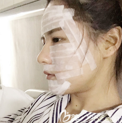 廣州軍美整形醫(yī)院脂肪填充術(shù)后3天自拍 廣州軍美整形醫(yī)院脂肪填充術(shù)后3天自拍