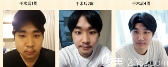 閔龍奎術(shù)后4周的變化情況