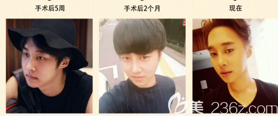 閔龍奎術(shù)后兩個(gè)月的變化情況