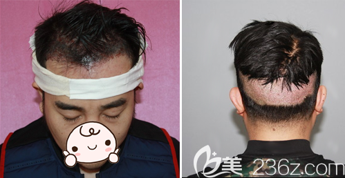 <!--<i data=20240703-sp></i>-->植發(fā)醫(yī)院徐霞發(fā)際線種植術(shù)后即刻