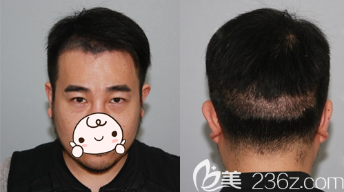 <!--<i data=20240703-sp></i>-->徐霞發(fā)際線移植術(shù)后10天恢復(fù)效果