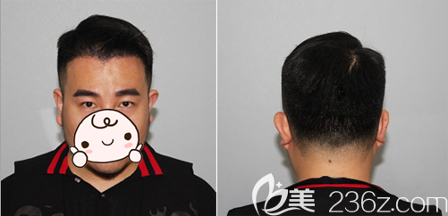 <!--<i data=20240703-sp></i>-->植發(fā)術(shù)后半年照片