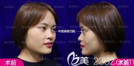在衡陽雅美做超體假體隆鼻術前照 在衡陽雅美做超體假體隆鼻術前照