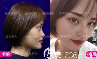 做超體假體隆鼻術后一周拆線 做超體假體隆鼻術后一周拆線