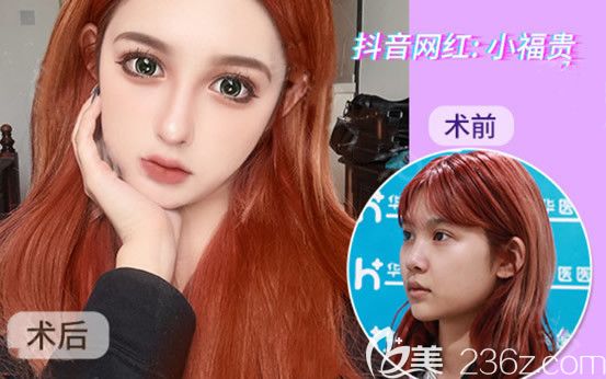 呼和浩特華醫(yī)整形半肋軟骨隆鼻和膨體隆鼻20天效果