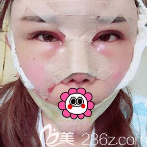 寧波童顏依美做完隆鼻和墊下巴手術(shù)后即刻