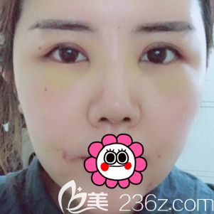 術(shù)后7天拆線后恢復(fù)的<span style=