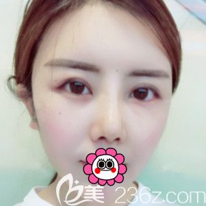 面部輪廓和隆鼻術(shù)后一個(gè)月恢復(fù)<span style=