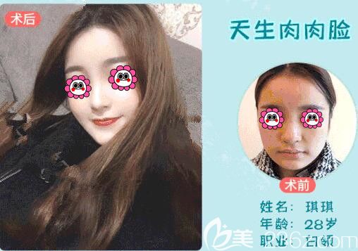 <!--<i data=20240703-sp></i>-->面部吸脂案例 <!--<i data=20240703-sp></i>-->面部吸脂案例