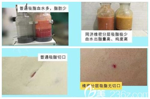 無錫同舟吸脂優(yōu)勢公開 無錫同舟吸脂優(yōu)勢公開