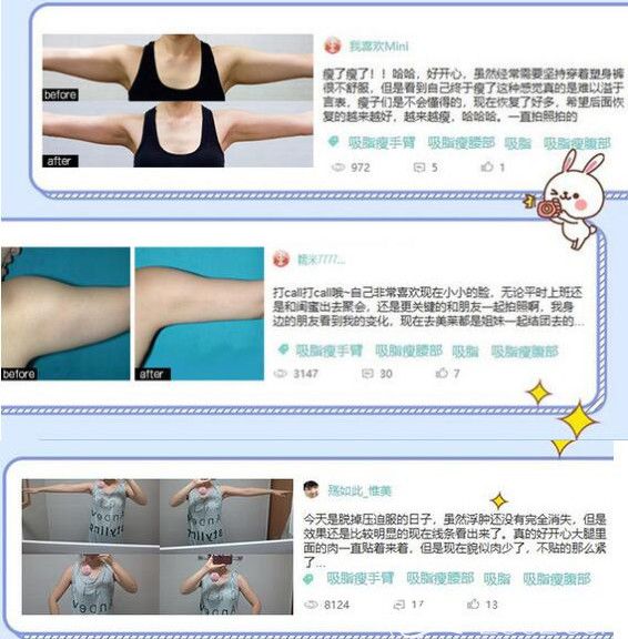 無錫愛思特吸脂評價 無錫愛思特吸脂評價