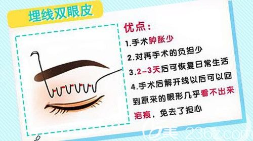 李晨霞醫(yī)生給我講述埋線雙眼皮的優(yōu)勢(shì)