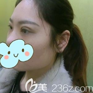 李醫(yī)生幫我做埋線雙眼皮術(shù)后4天眼部腫脹