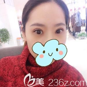 在太原時(shí)光做埋線提升術(shù)后15天線條流暢