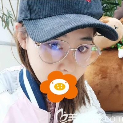 將我在廈門薇格整形找高勇醫(yī)生做肋軟骨綜合隆鼻案例對比圖分享出來