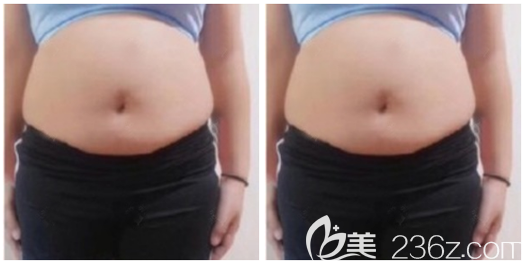 在佛山曙光金子整形醫(yī)院做吸脂術(shù)前照片 在佛山曙光金子整形醫(yī)院做吸脂術(shù)前照片