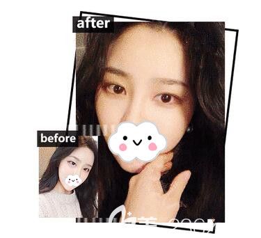 徐州市礦務集團<i data-id='204f9c87-cffb-447b-9882-00a8eb82af1b' style='display:none;'></i>整形美容中心花2800做的自然小內(nèi)雙 徐州市礦務集團<i data-id='204f9c87-cffb-447b-9882-00a8eb82af1b' style='display:none;'></i>整形美容中心花2800做的自然小內(nèi)雙