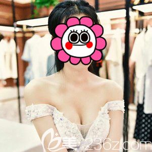 杭州藝星假體隆胸術(shù)后十天<span style=