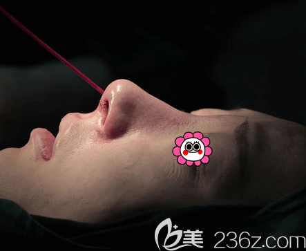 劉彥軍醫(yī)生給我做鼻修復(fù)術(shù)后即刻照